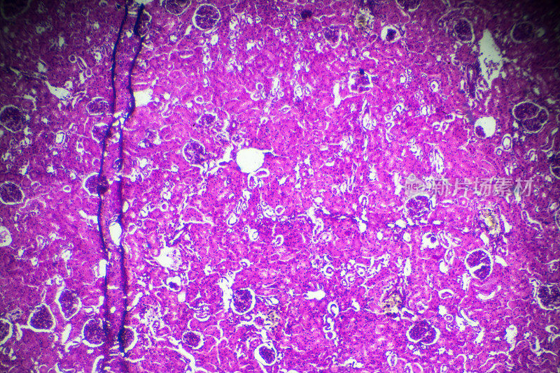 显微镜下急性肾盂肾炎活检标本