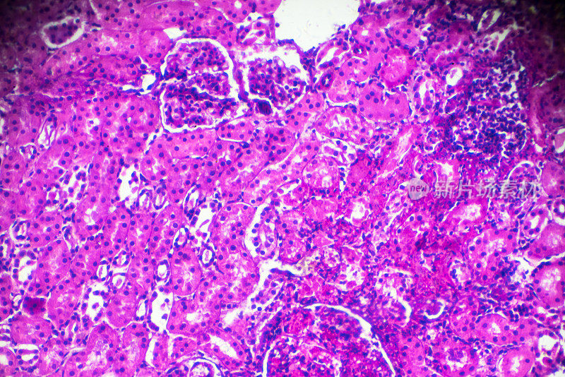 显微镜下急性肾盂肾炎活检标本