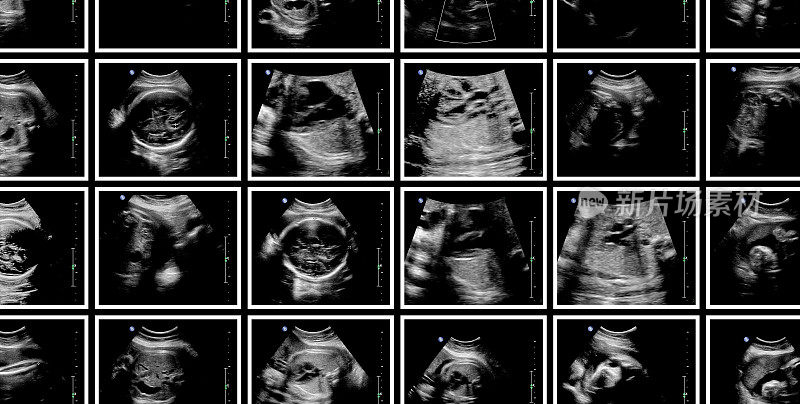 一系列胎儿超声图像。第7个月怀孕
