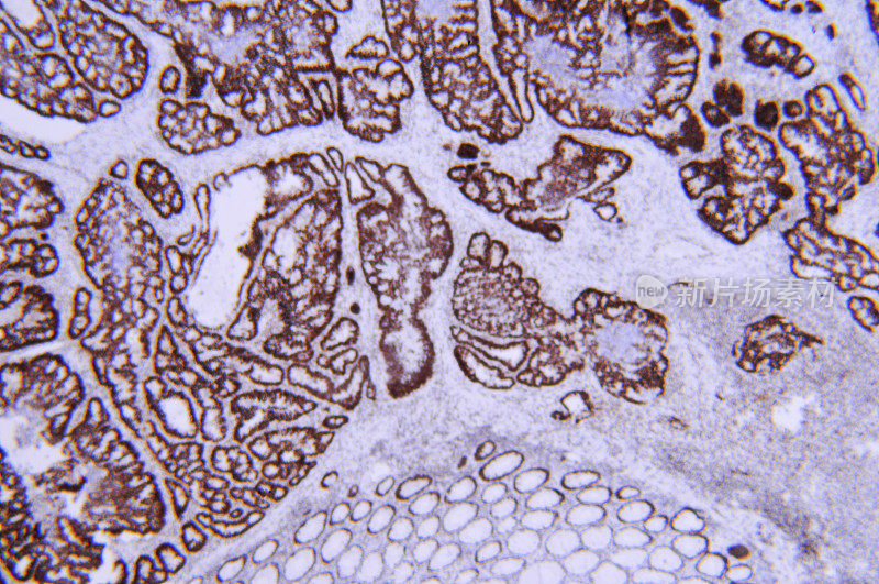 显微镜图像结肠癌