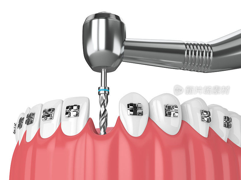 牙齿的3d渲染与矫正牙套和牙钻