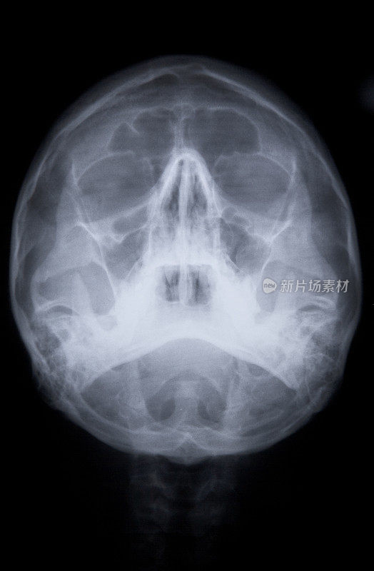 23岁男性颅骨x光片