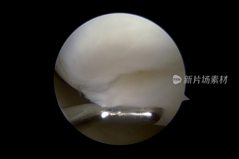 右膝内侧腔室关节软骨撕裂的关节镜照片