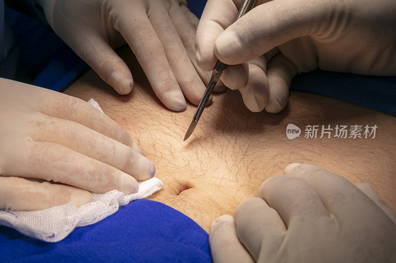 医生在医院手术室里做手术的双手。外科医生用手术刀做手术的手特写。
