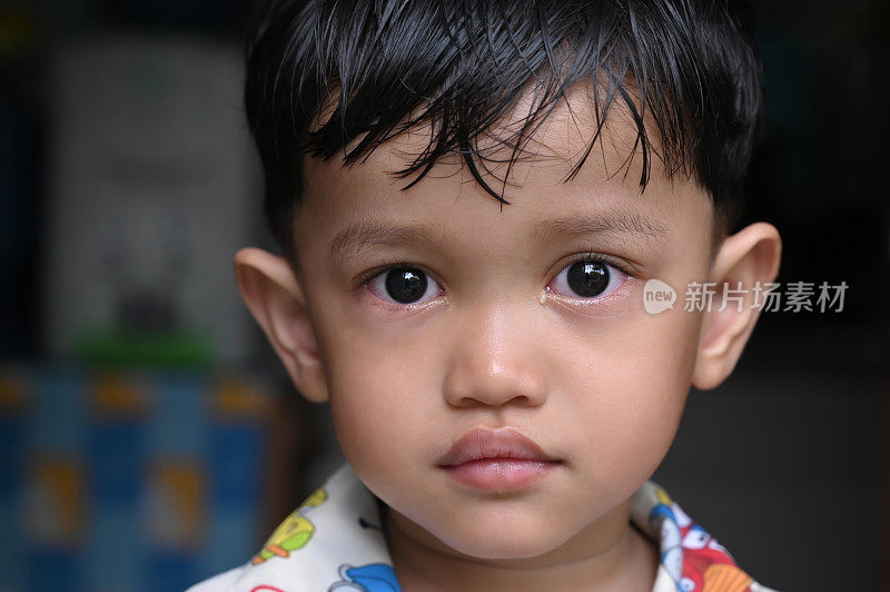一个患有眼疾的孩子的画像