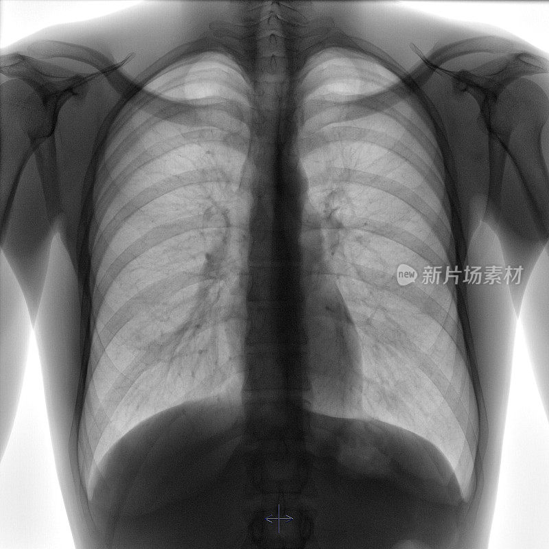 一个健康年轻人的胸部x线照片