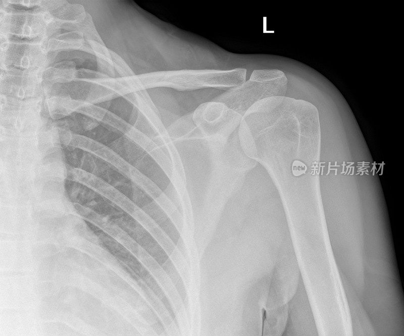 健康成人肩部的数字x光片