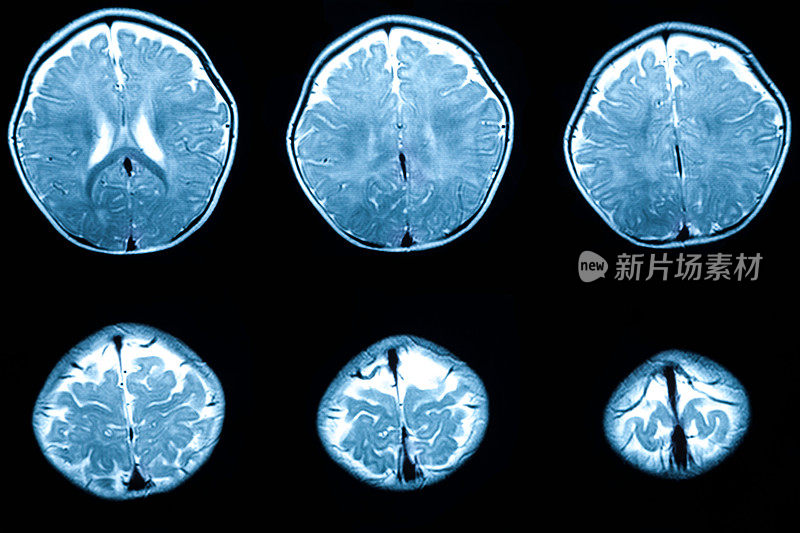 婴儿脑部MRi显示脑白质病变和发育异常