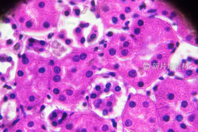 显微镜下急性肾盂肾炎活检标本
