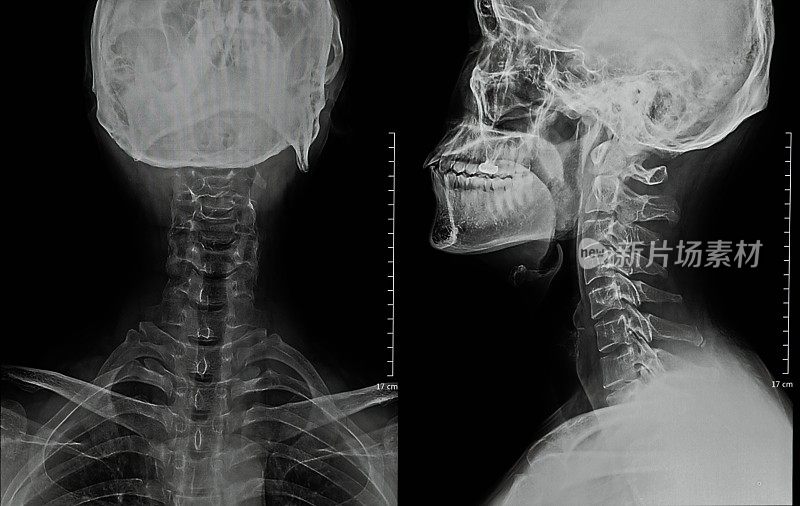 人类颈x射线