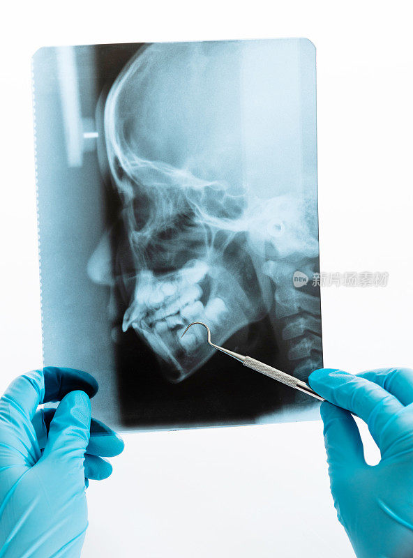 牙医拿着一张白色背景的x光片