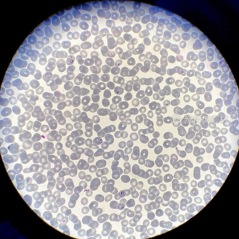 疟疾寄生虫已经感染了多个红细胞