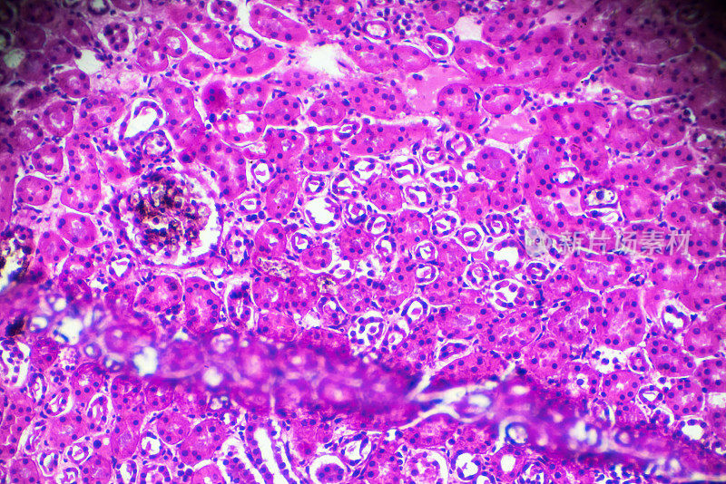 显微镜下急性肾盂肾炎活检标本