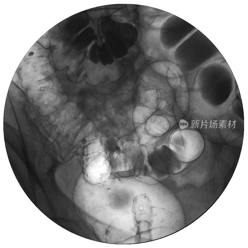 大肠钡剂灌肠造影或x线造影。结直肠x射线
