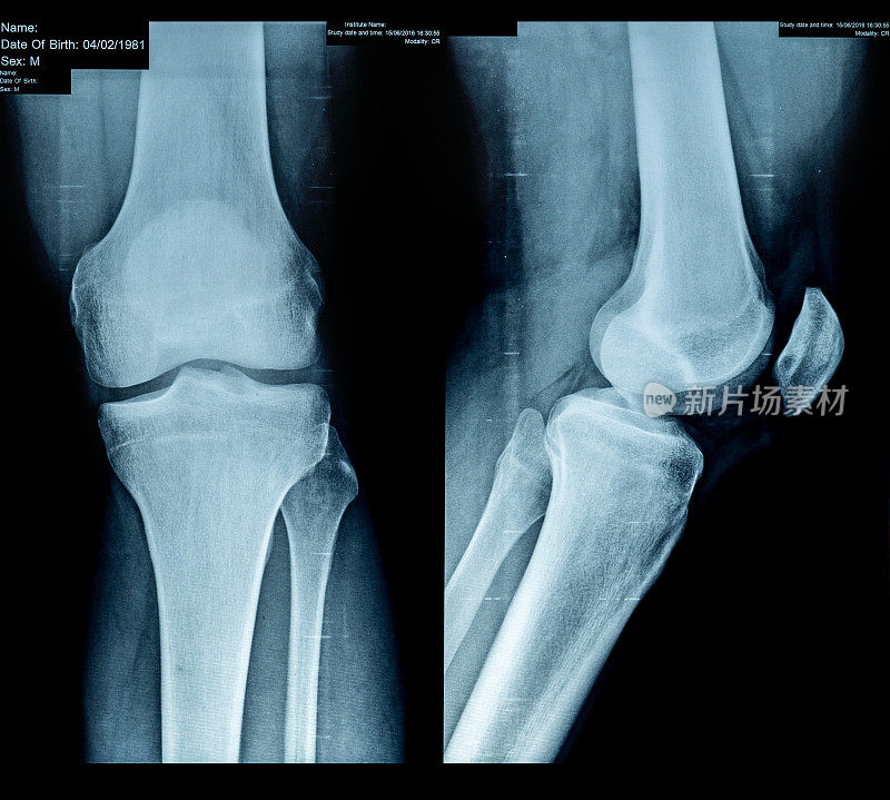 x射线的膝关节
