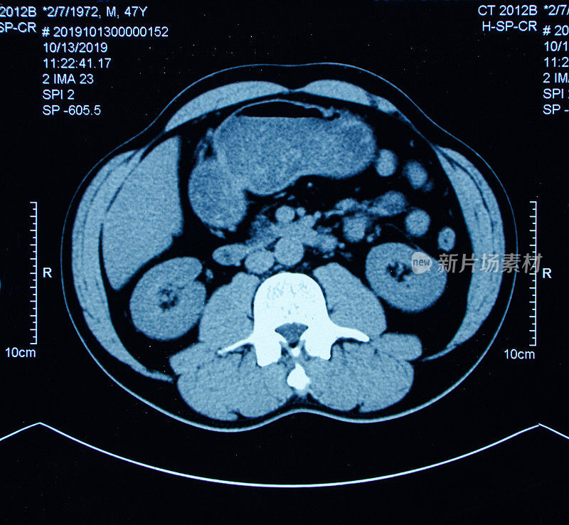 腹腔断层扫描