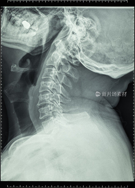 人体头颈部x光片