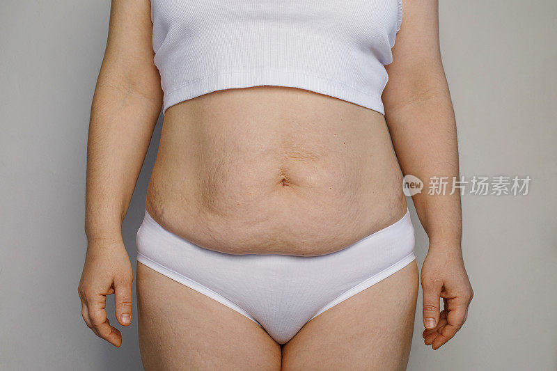 女性肚子肚子上有妊娠纹和体重减轻。一个女人的特写。护肤，超重，肥胖，超大，饮食和减肥的概念