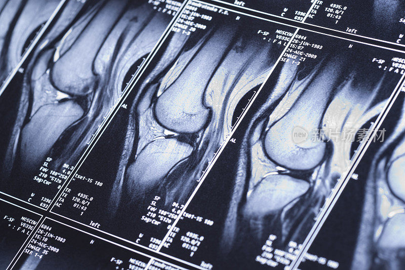 膝关节MRI显示十字形韧带损伤