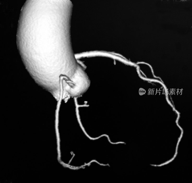 容积显示心脏和冠状动脉的CT图像