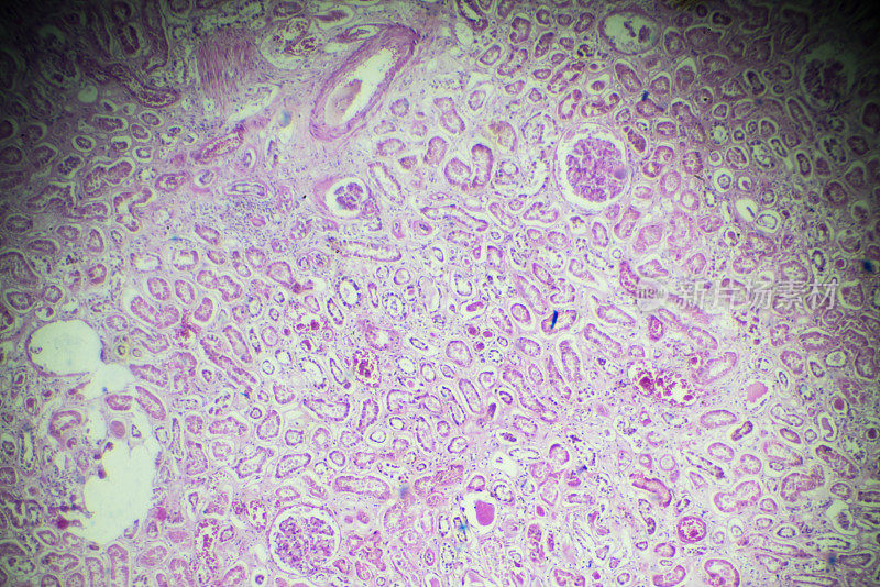 显微镜下急性肾炎活检标本
