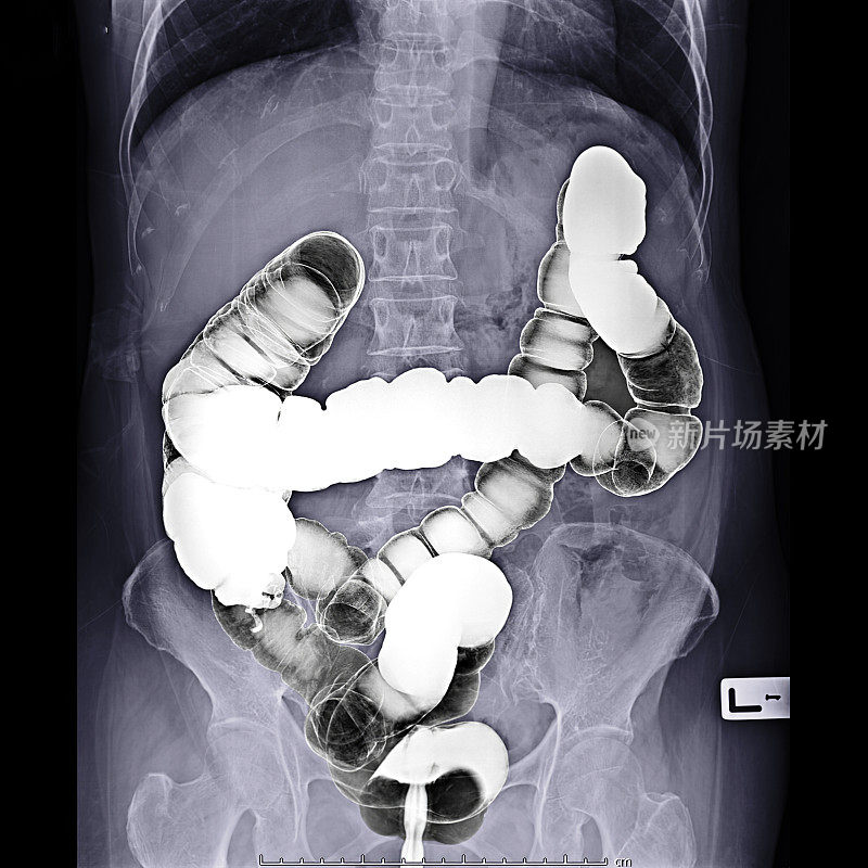 大肠钡剂灌肠片或x线片，俯卧位显示结肠解剖结构以检测结肠癌。剪切路径。