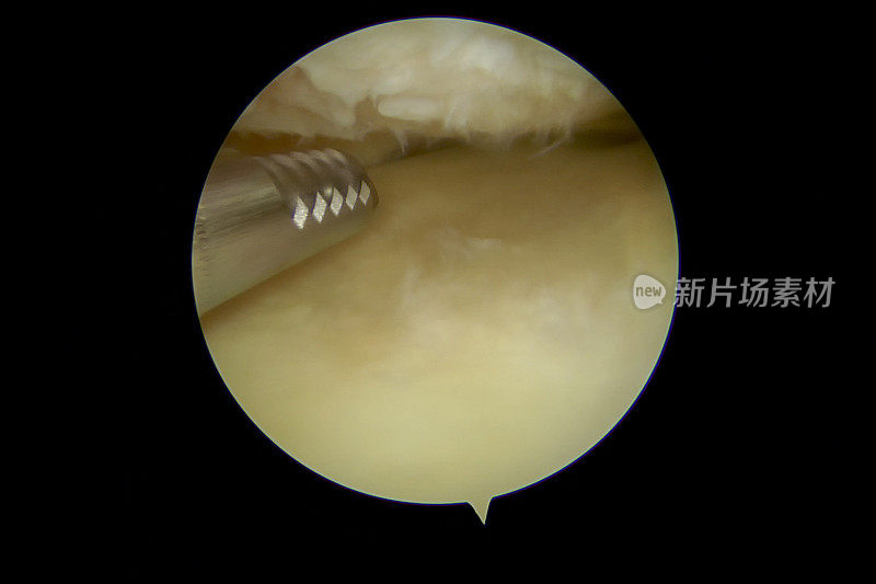 患有轻度至中度骨关节炎的人左膝内侧腔室的关节镜视图