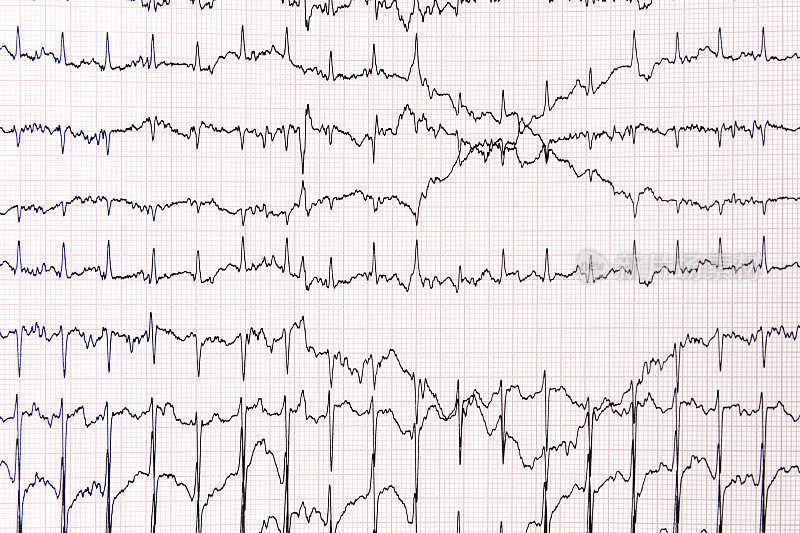 图表心电图(ECG)