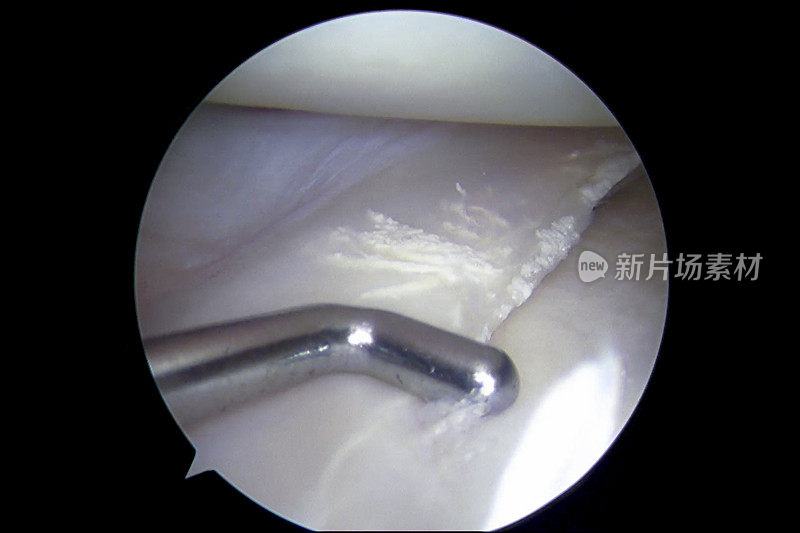 膝关节骨性关节炎和退行性半月板撕裂的关节镜观察