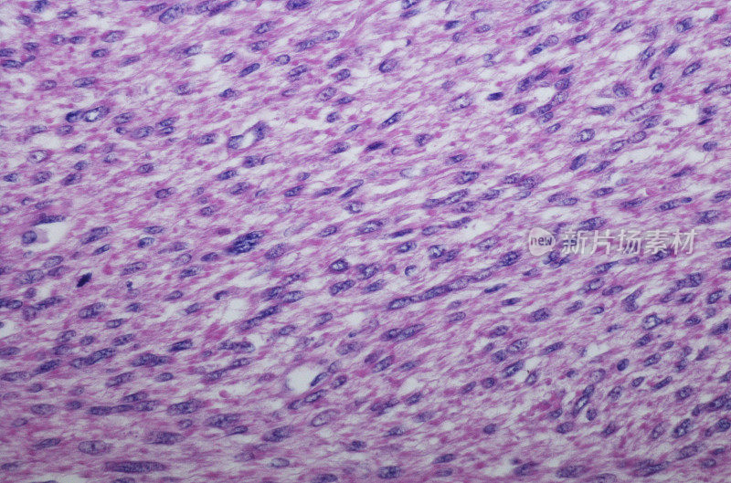 胃平滑肌肉瘤(LMS)的显微照片