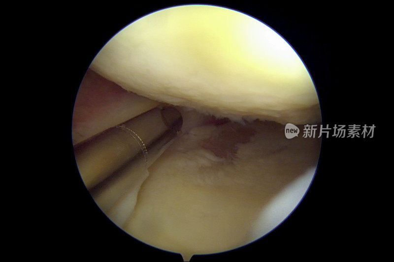 骨关节炎患者膝关节的关节镜观察