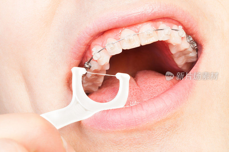 戴牙套的人用牙线剔牙