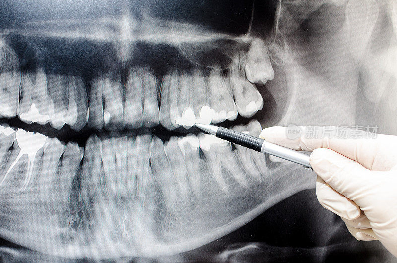 牙科医生在牙科x光图像上显示了一些东西