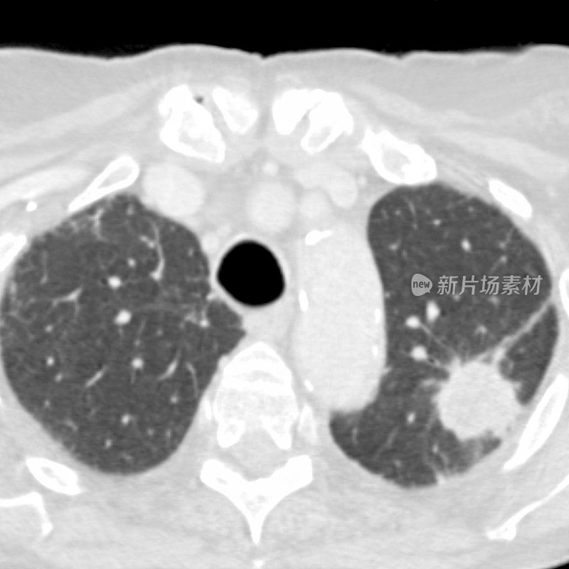 吸烟者肺癌胸部CT扫描