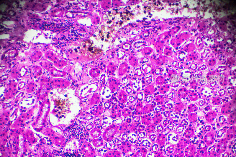 显微镜下急性肾盂肾炎活检标本