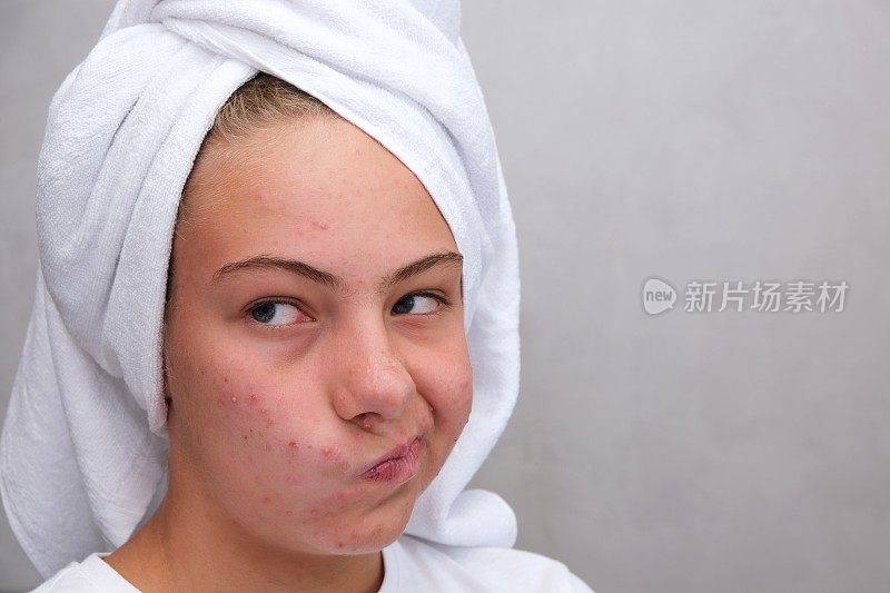 粉刺。一个十几岁的女孩扭曲了她的脸，她不喜欢，因为痤疮。