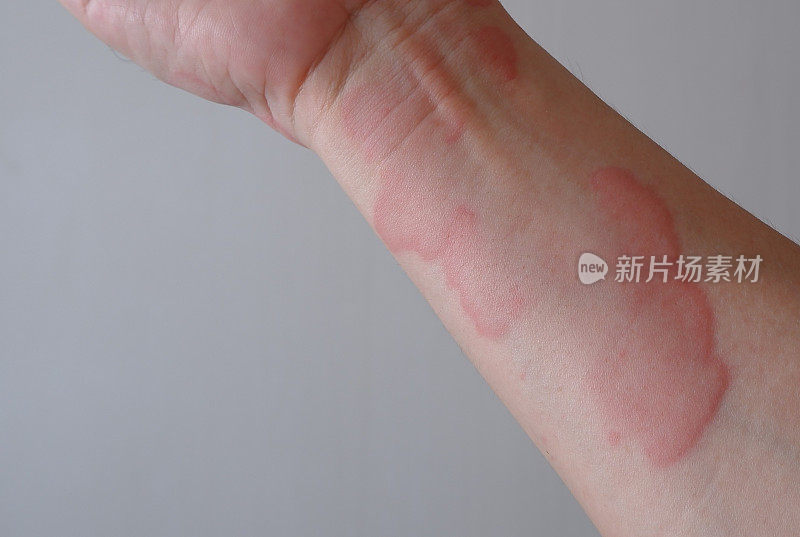 皮肤纹理的特写图像遭受严重的荨麻疹或荨麻疹或卡利塔在手腕上。过敏症状。