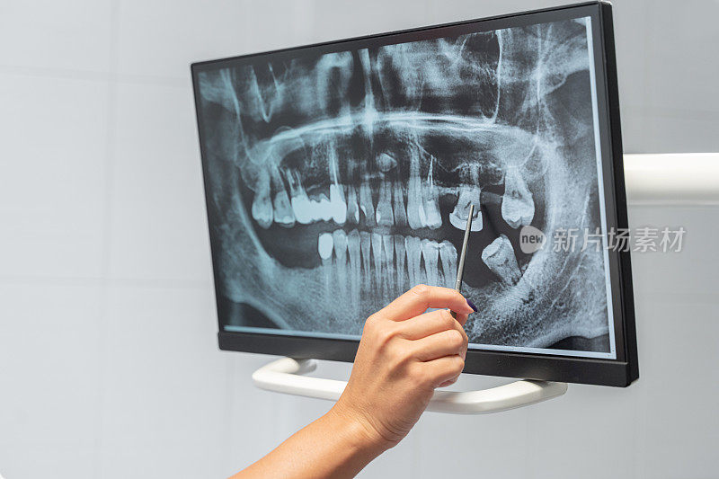 近距离的牙医手探索牙齿x光监视器描述治疗病人在牙科办公室。口腔卫生正畸治疗，牙齿保健检查