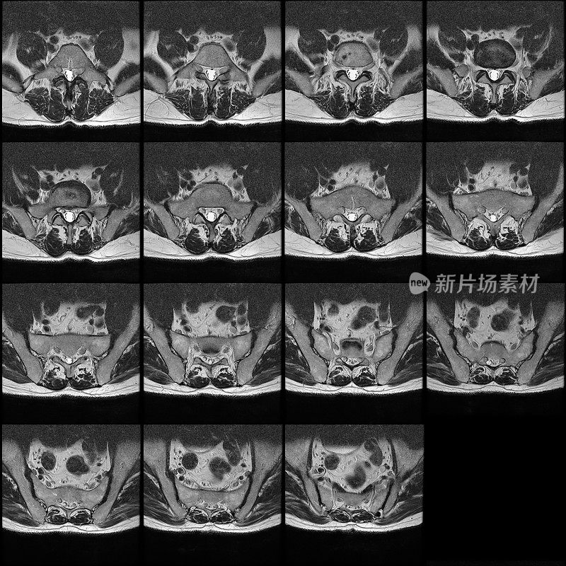腰椎(脊柱)MRI横切面切片