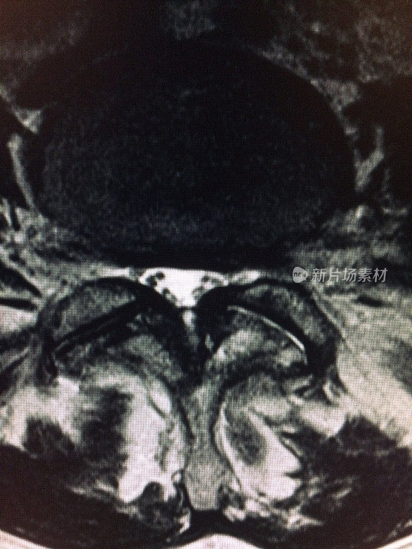 MRI腰椎轴向视图显示严重狭窄