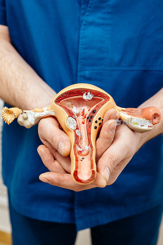 医生拿着子宫和卵巢模型。卵巢癌和子宫颈癌，子宫颈疾病，子宫内膜异位症，子宫切除术，子宫肌瘤，生殖系统和妊娠概念