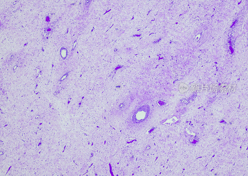 积极angiomyxoma