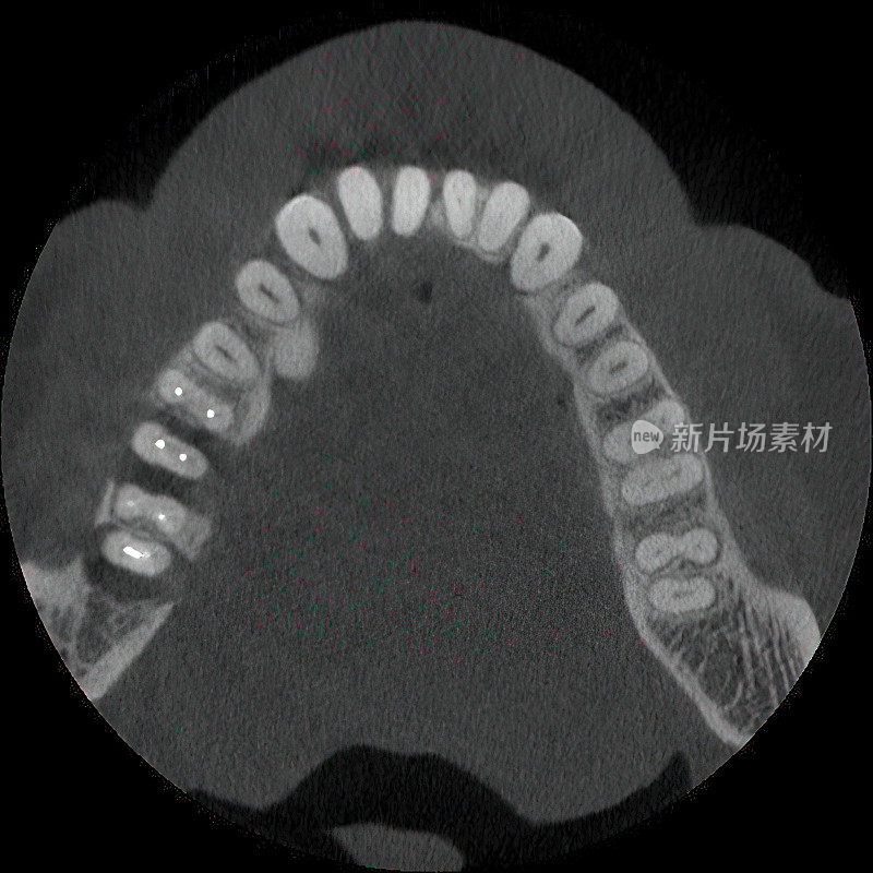 牙科断层扫描病人的CT扫描