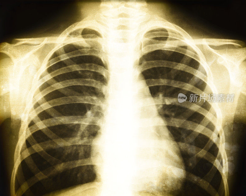 胸部的旧x光影像