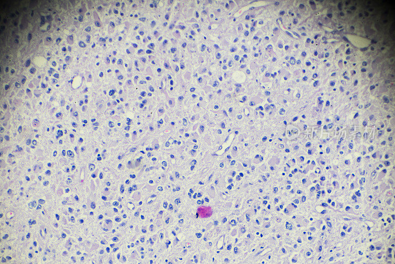 显微镜下观察睾丸生殖细胞瘤