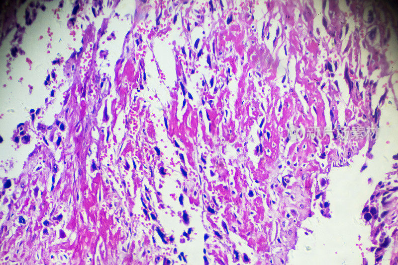 绒毛膜癌活检显微镜下