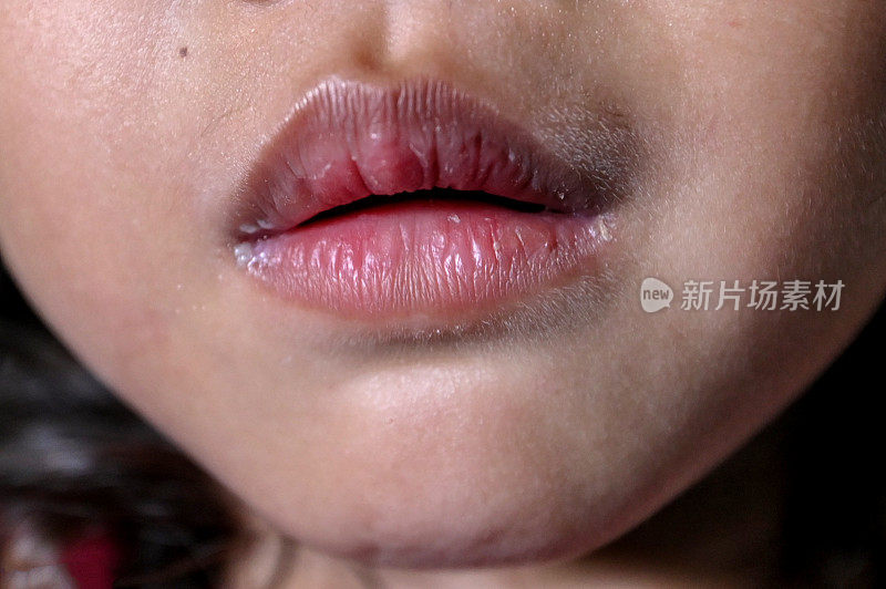 儿童的嘴唇缺乏维生素c