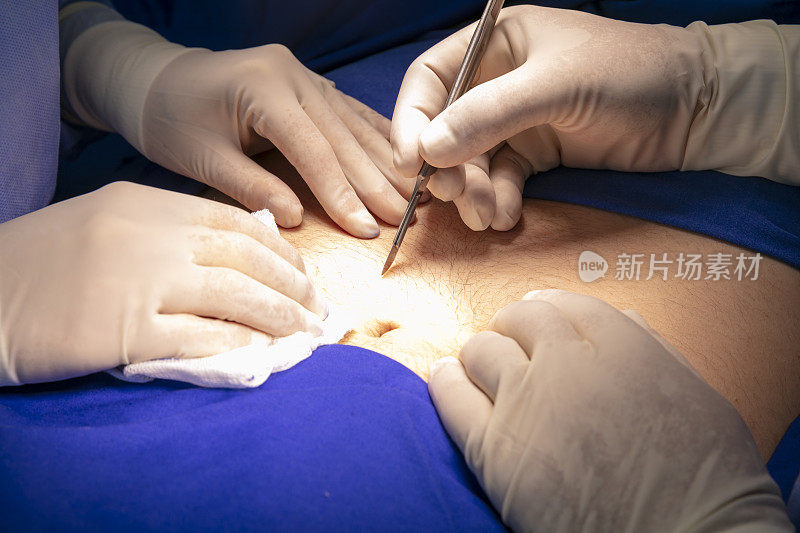 医生在医院手术室里做手术的双手。外科医生用手术刀做手术的手特写。