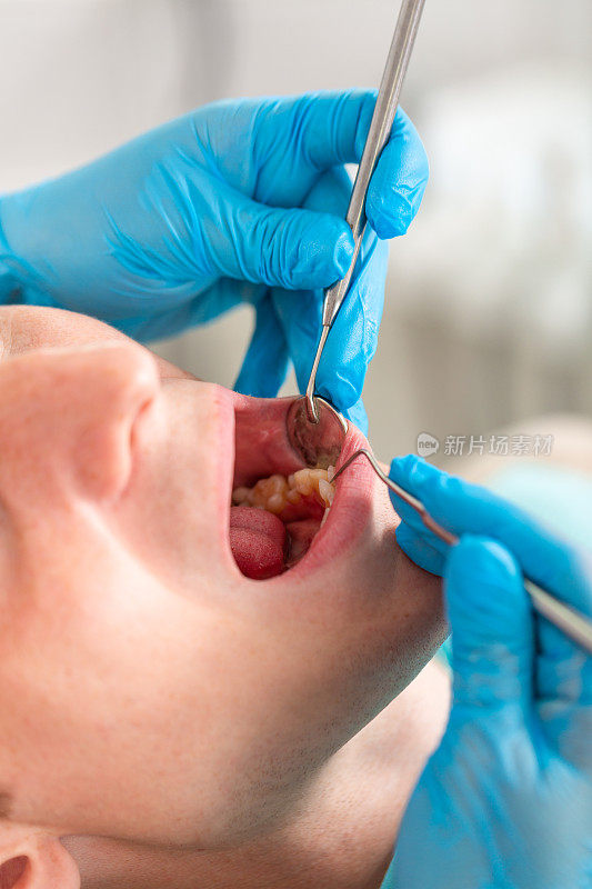 女牙医用带镜子的工具检查病人的口腔。病人张着嘴的特写，戴着手套的医生拿着牙科镜。
