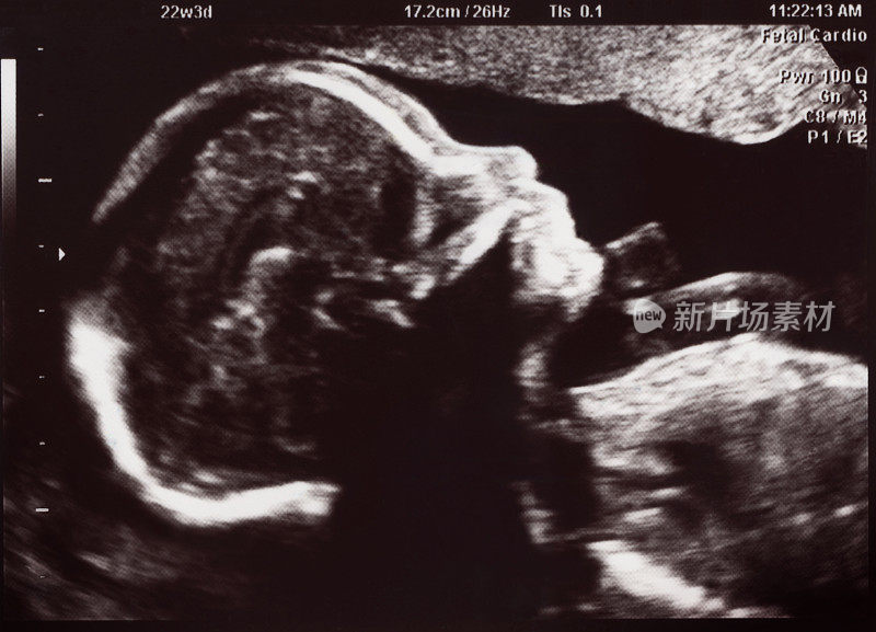 22周胎儿超声检查